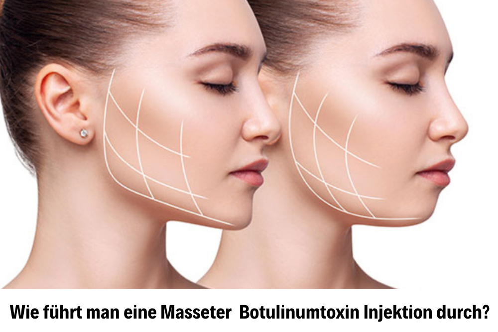 Masseter Faltenbehandlung